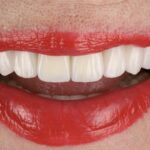 Коли повна імплантація стає найкращим рішенням